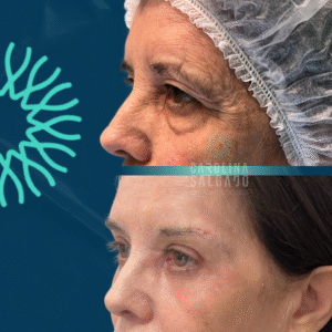 Blefaroplastia & Laser CO2